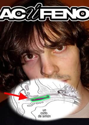 Acúfeno