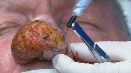 Lessons in Pimple Popping